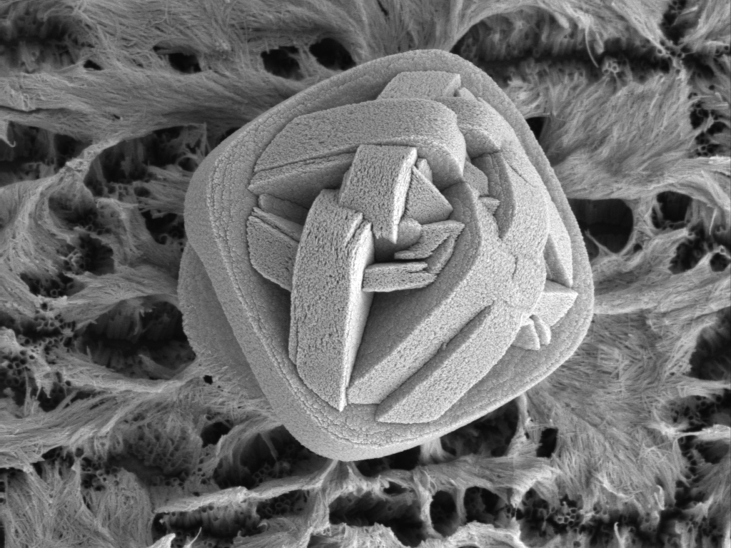 A single TiO2 defect on the surface of a heart stent